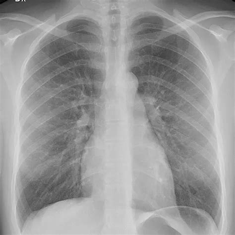 apicolordotic view treatment|Detection of Lung Opacity and Treatment Planning with Three .